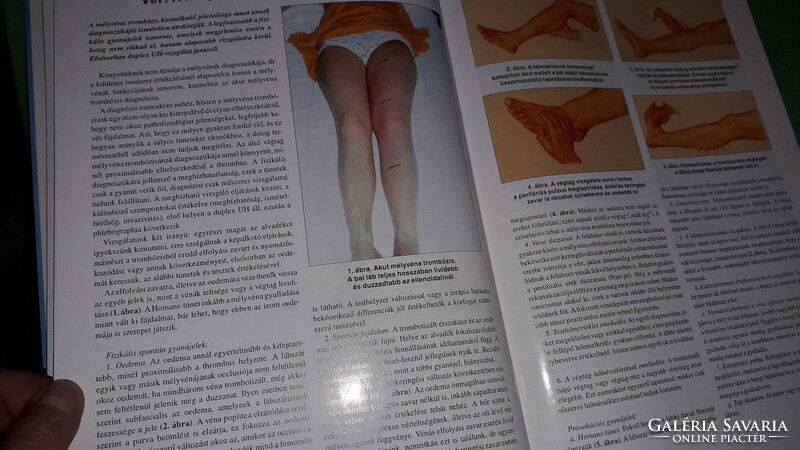 2004.Dr. Imre Bihari: varicose vein disease and its treatment book according to the pictures is published by á + b